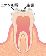 C1：歯の表層（エナメル質）の虫歯
