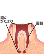 C4：歯質が失われた虫歯（残根状態）