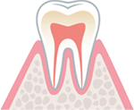 痛みはなく自覚症状のない虫歯