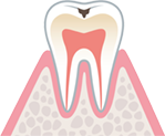 歯の表層（エナメル質）の虫歯