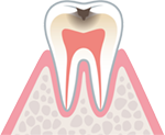 象牙質に達した虫歯