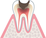 歯髄に達した虫歯