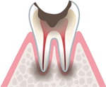 歯質が失われた虫歯