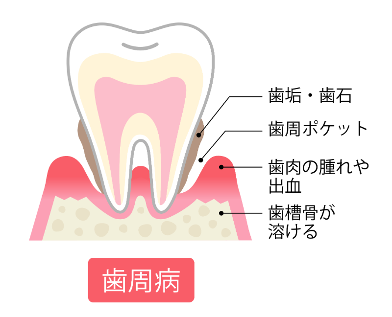 歯周病